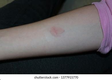 mt test positive images|199 Mantoux Test Images, Stock Photos, 3D objects, & Vectors.